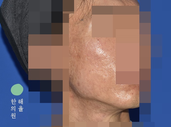 [울산점] 얼굴화농성여드름 치료 후 사진 - 해율한의원